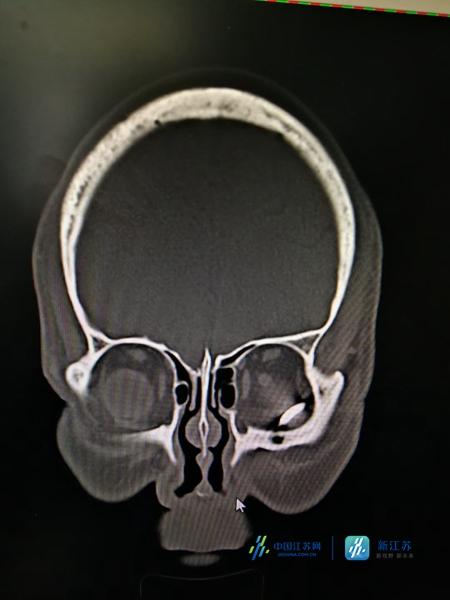 铁钉|铁钉扎入眼眶整整三天 南京市第一医院医生妙手取出
