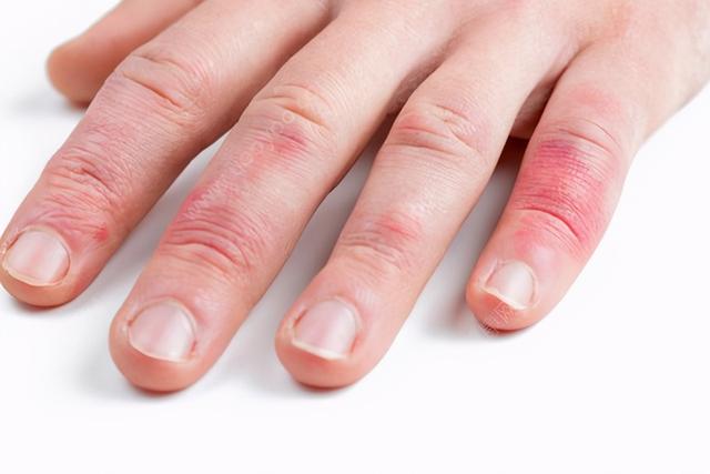 一旦得冻疮，年年都会痒？冻疮真的不能根治吗？