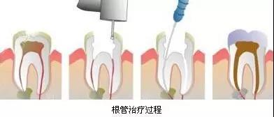 补牙，为啥不能一次完成？补牙后为什么还是牙疼？