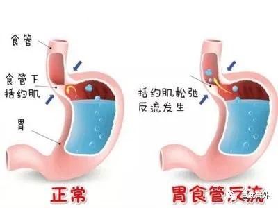 食管|为何反酸、烧心钟爱老年人？