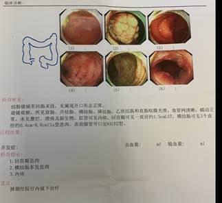 早期肠癌不痛不痒,医生提醒:出现6个异常,病情或已到