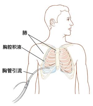 引流量|为何手术之后要带根管？