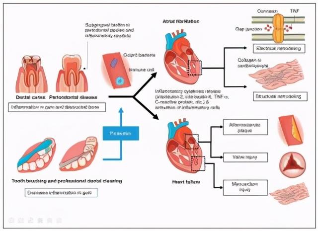 研究揭示：刷牙竟然也能救命，比如“防猝死”