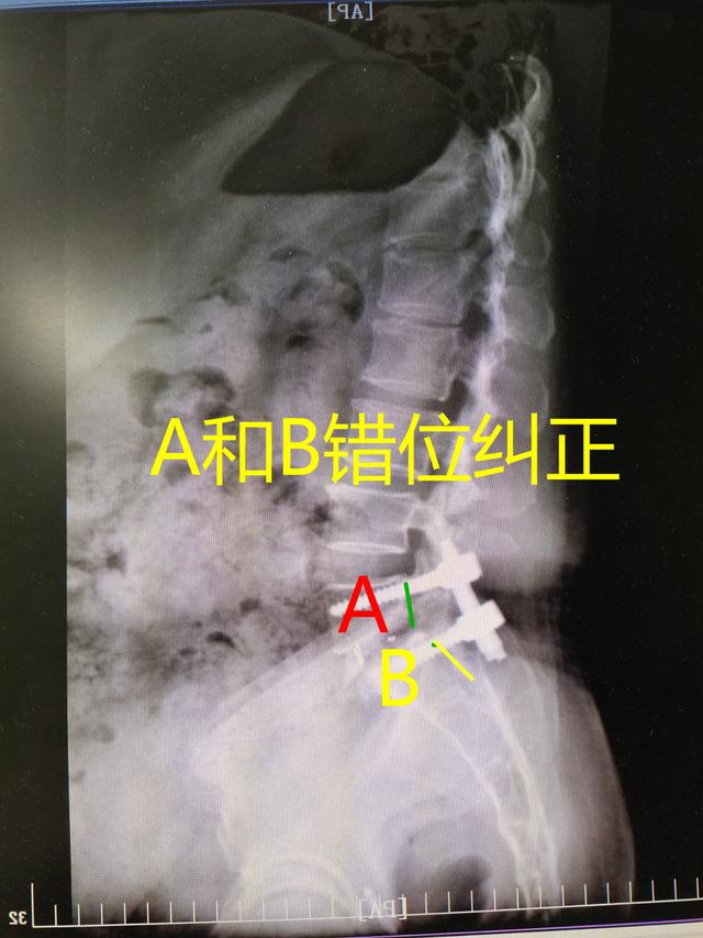 腰椎间盘突出到底该不该手术？