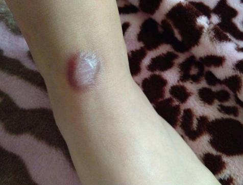 阳阳的家|4岁男宝被烫伤，3小时后竟却被送医抢救，医生：奶奶太无知了
