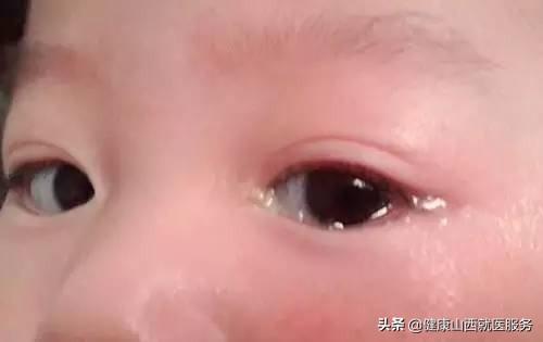 甜蜜妈妈|宝宝总是眼泪汪汪，还有眼屎，是上火了吗？