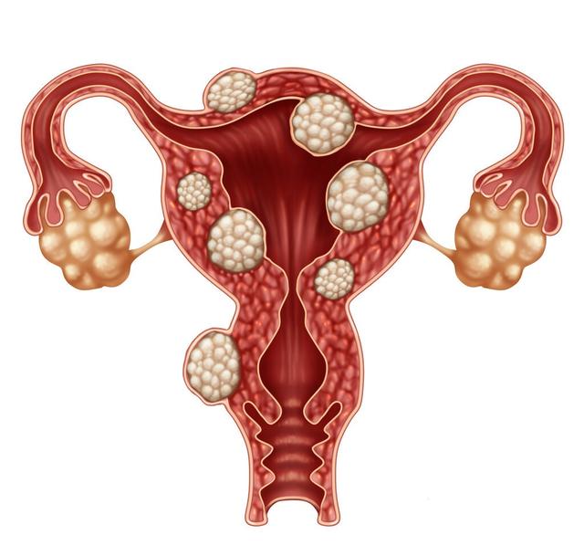 女人该知道：子宫生病了怎么办？切子宫须慎重