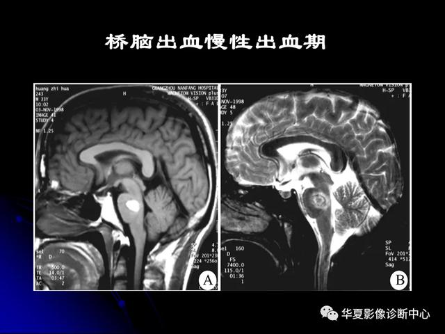 「影像复习」脑干区常见病变影像表现