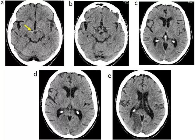 脑梗死患者的头部CT，你真的会看吗？丨实战读片
