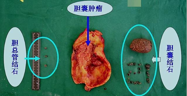 今天给大家简单的介绍一下什么是胆囊结晶？胆囊结晶就是胆结石