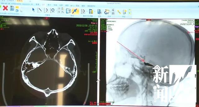 找都找不到！刀片击入男子脑内整两周！来沪就医后发现…