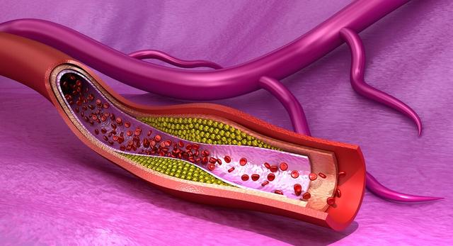 颈动脉发现了斑块，可以用阿司匹林治疗吗？不是所有人都需要