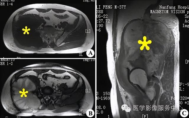 77种骨肌影像病例，助你诊断无忧