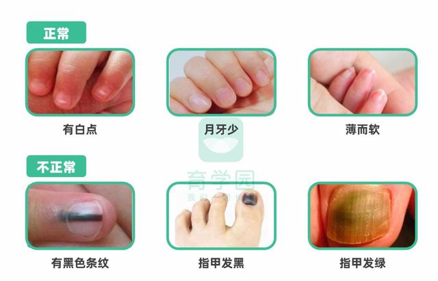 [你的育儿经]孩子身上出现这些颜色，是健康警报，却总被忽视