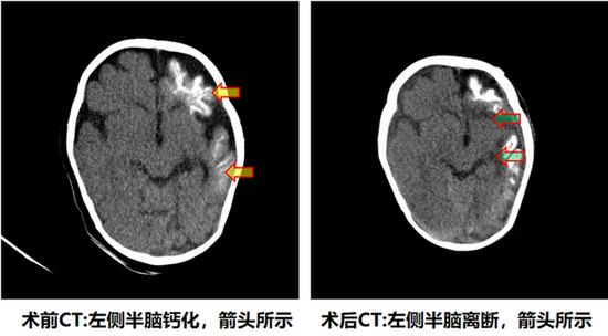 癫痫|面部红斑宝宝一天癫痫发作60余次 半球离断术为其除病魔