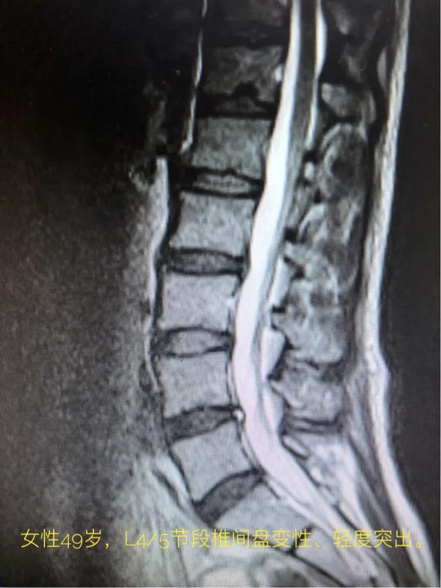 有一种“腰椎间盘突出症”，其实是颈椎病！