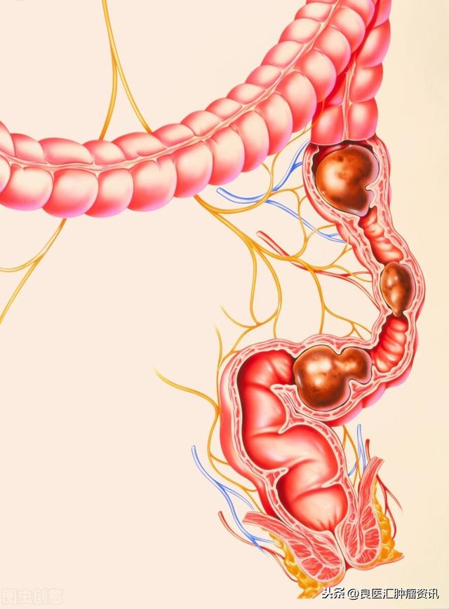 担心！直肠癌的误诊率近70%，我们该如何避免被误诊？