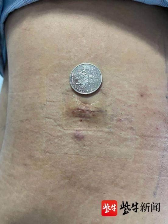 手术|250斤胖小伙“腰突”了，腰上开7毫米小口子完成手术