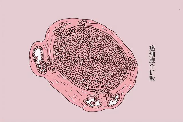 不想癌细胞扩散，2个建议要记在心里，长期坚持，有助抗癌