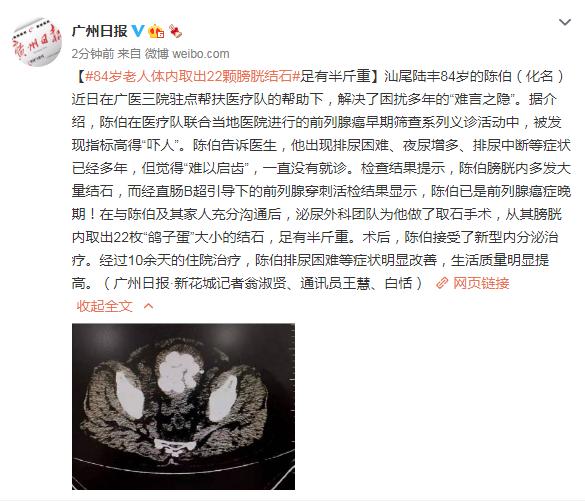 陈伯|84岁老人体内取出22颗膀胱结石，足有半斤重