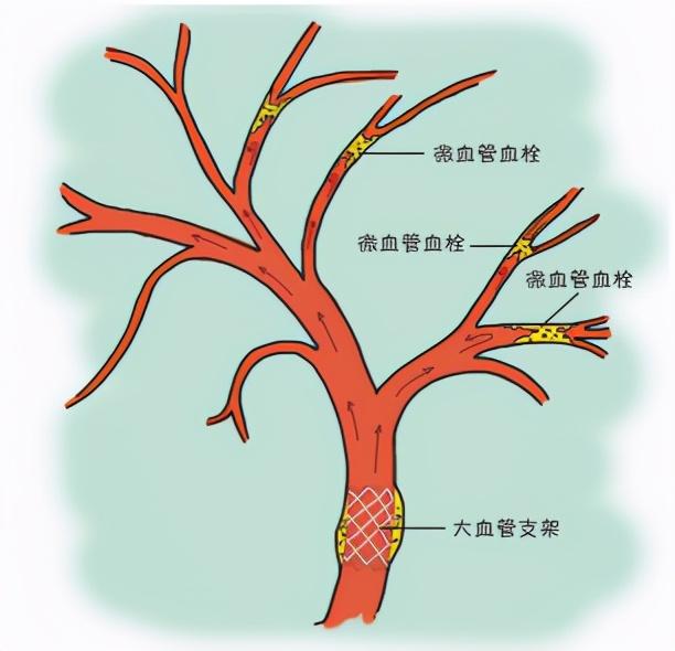 如何保护人体血管系统？这一药物获官方认可