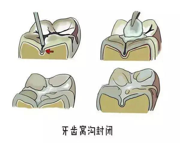 超级宝妈|惨！小孩1月内牙齿全部掉光！家长到底该怎么做？