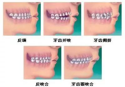 #你的育儿经#牙齿不齐的缘由（一）——遗传因素