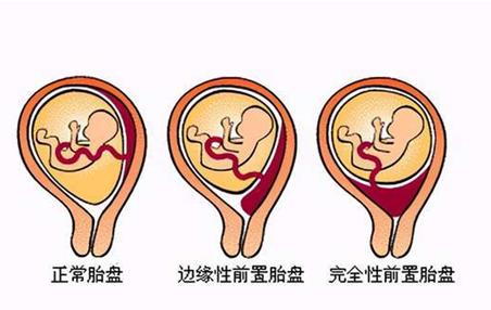 孕妈妈与龙凤胎宝宝性命攸关，怀化市二医院多学科联动救治