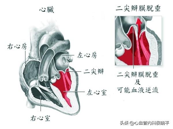 瓣膜|心脏“瓣膜反流”，是心脏病吗？