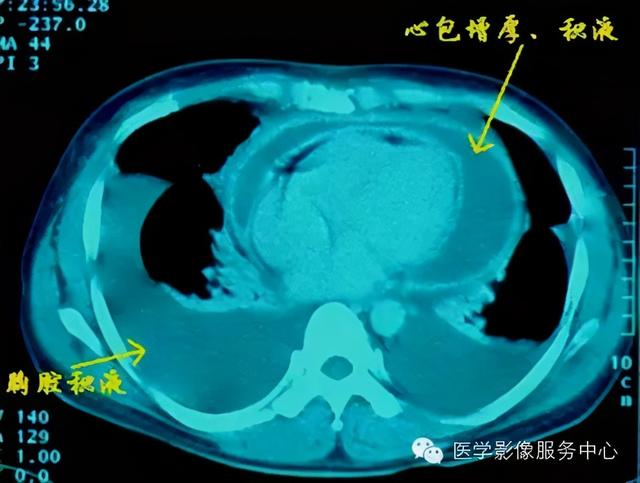 心包积液的影像学检查