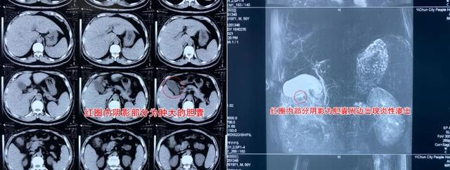 胆囊|男子频繁腹痛患胆结石致胆囊穿孔：痛到内脏都受不了