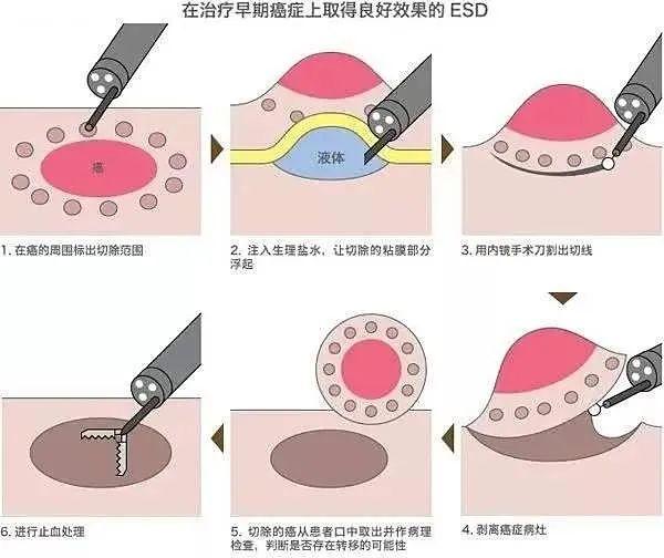 病变|新平台 新力量丨郑昌荣——(ESD)内镜下粘膜剥离术