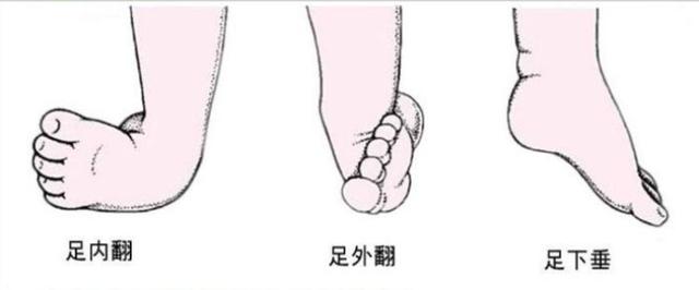 「你的育儿经」2岁宝宝因鞋不合适，造成“足外翻”，这几种鞋子别再给孩子买了