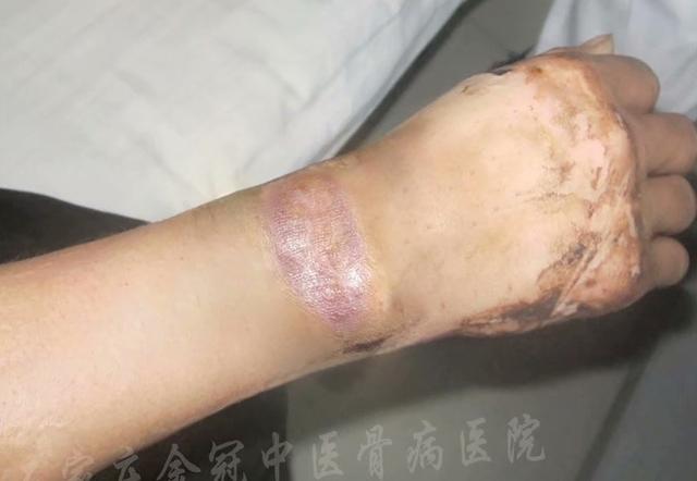 小心！被铁门夹伤未在意，竟恶化成了顽固性皮肤溃疡