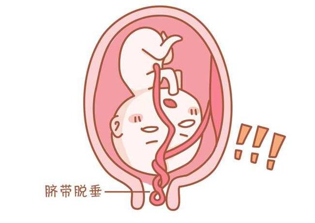 你的育儿经■生死时速！高邮一产妇突发脐带脱垂，医生5分钟救活