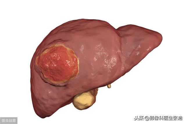 甲胎蛋白AFP|都说验血能查出癌症，发现肿瘤指标异常就是患癌症了？#辟谣#