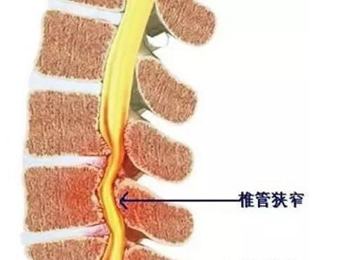 “骑车行百里，步行百步难”是什么病？骨科医生与您聊一聊