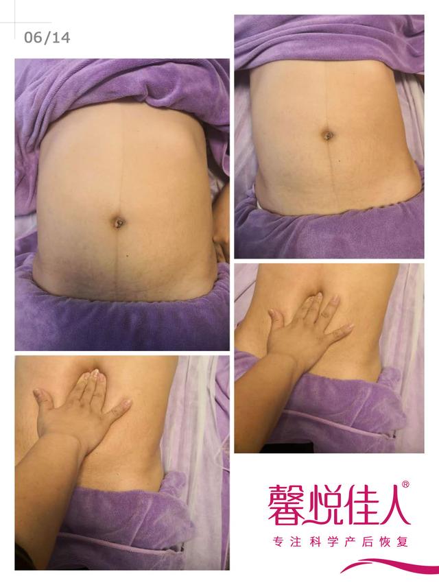 南浔的梦|孕前小蛮腰，产后变肉包，那是因为你的腹直肌分离了