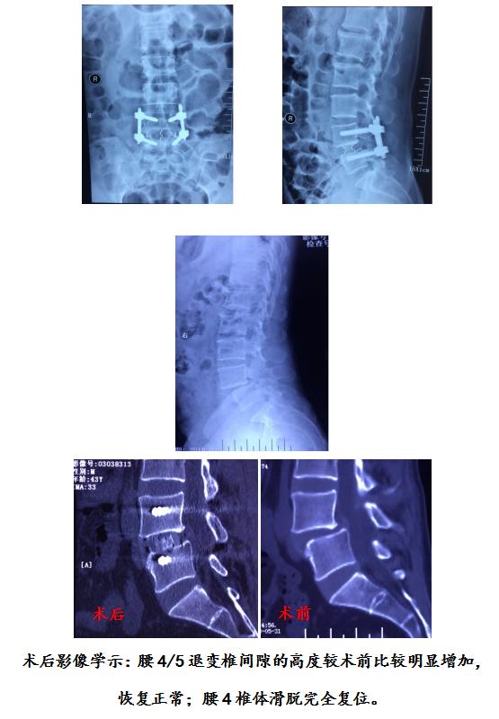 病例：腰椎斜前方入路椎间融合术+后路经皮内固定术