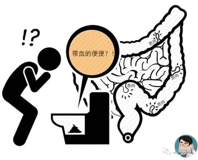 冬季得溃疡性结肠炎，如何治疗？