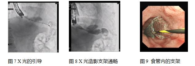 一招鲜！半年不能进食的老大爷终于能饭从口入了