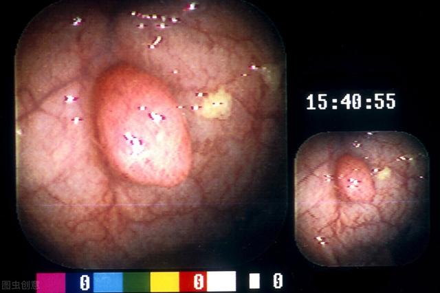长了息肉要不要切？先“三看”会不会恶变，心里就有底了
