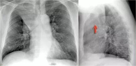 一文总结肺不张的影像学表现丨以影识病