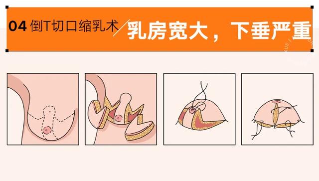 各类人群的乳房缩小术