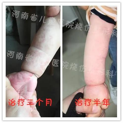 大河微医|新生宝宝手臂颜色似“鸡血石”？医生：这是病，得治