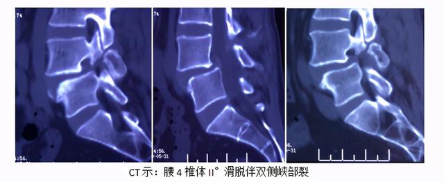 病例：腰椎斜前方入路椎间融合术+后路经皮内固定术