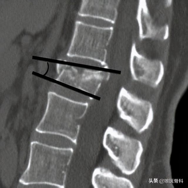 骨折拍了X线，为什么还要做CT和磁共振？