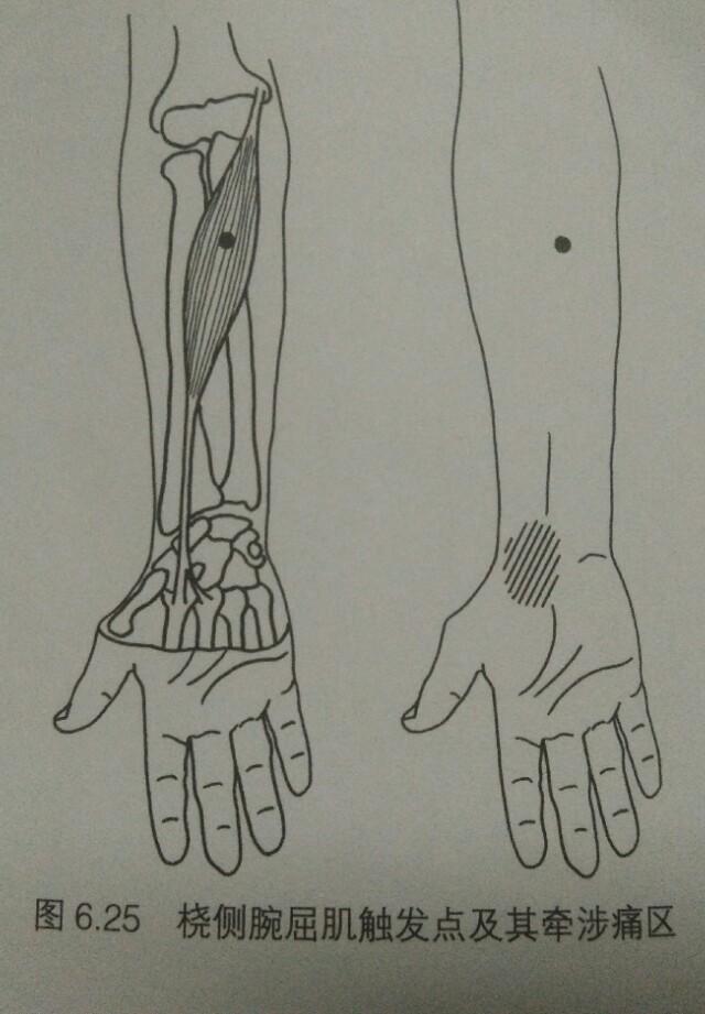 怎么通过按摩来缓解"腕管综合征","狭窄腱鞘炎"――手腕疼痛