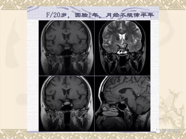 垂体病变的MRI诊断