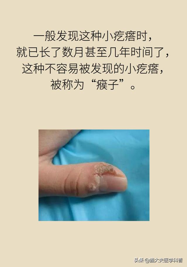 身上长瘊子，越挠它越多，竟是因为感染了HPV